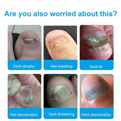 Toenail Fungus Treatment Extra Strength Nail Repair Foot Care